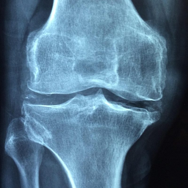 Bone & Joint Health